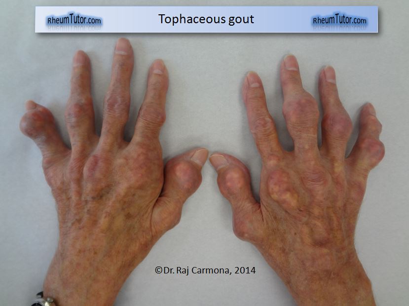 bệnh Gout mang lại nhiều đau đớn